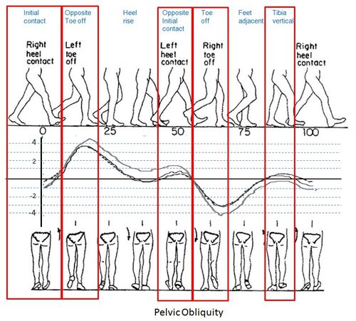 Pelvic obliquity